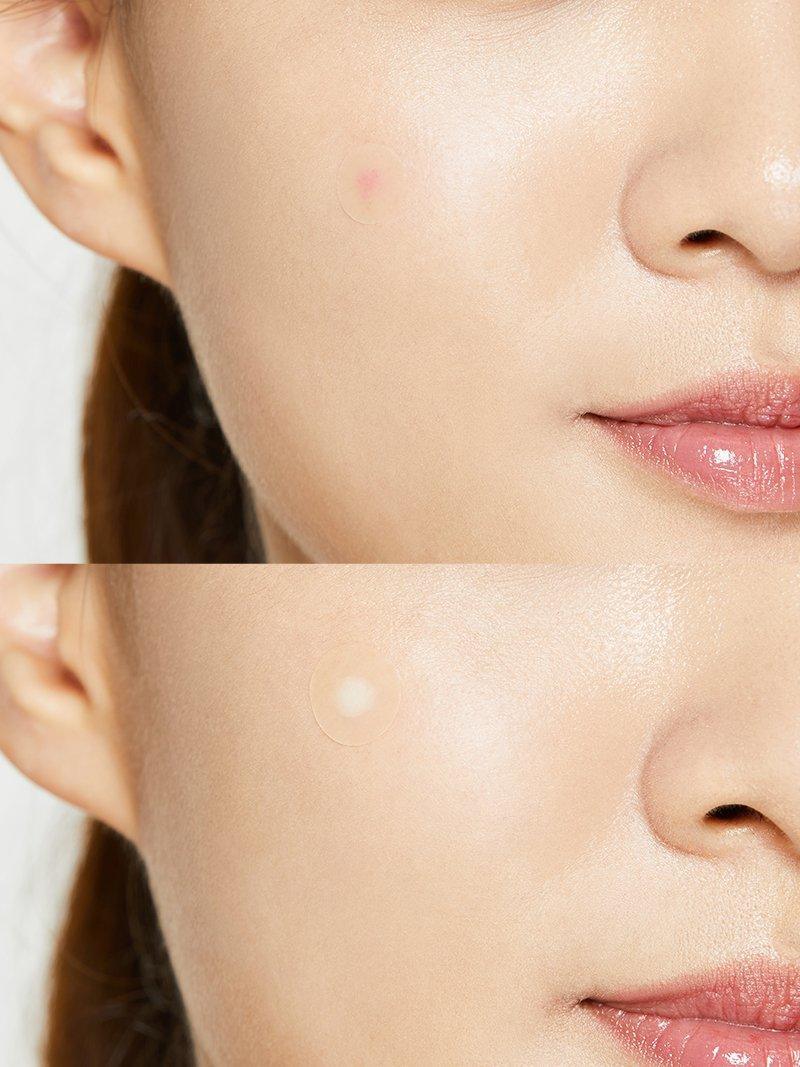 COSRX Acne Pimple Patches hydrocolloid technology